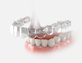 Transparent retainer fixed on lower jow.