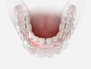 Transparent retainer fixed on lower jow.