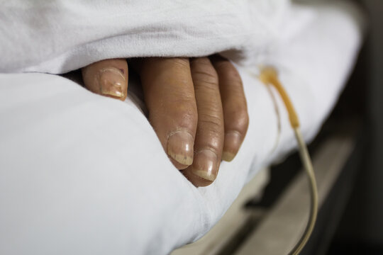 closeup of hepatitis patient's hand