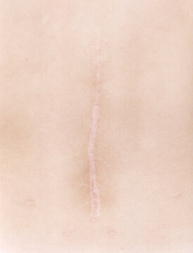 Scar