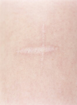 Scar