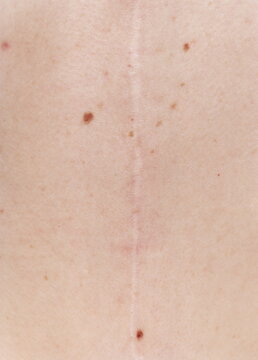 Scar