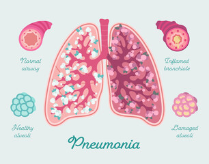 Pneumonia in lung of human. Inflammation lung - hand drawn illustration. Airway, bronchiole and alveoli filled by mucus. Patient-friendly diagram of COVID-19 Pneumonia. Comparing with healthy lungs