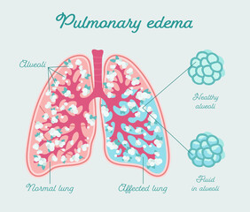 Pulmonary edema - Anatomical scheme in hand drawn style. Collection of liquid in human lung. Fluid in lung and alveoli - cross section. Comparison normal and edema lungs