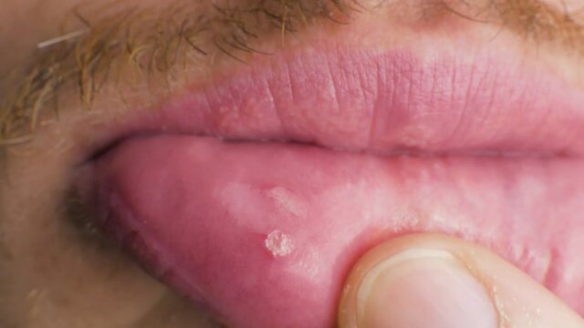 an aphtha oral inflammation on the gums CLOSE UP