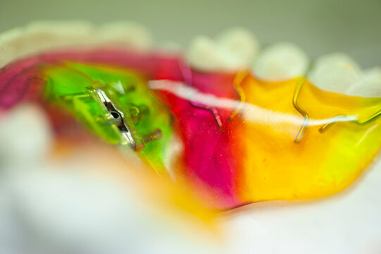 Zahnklammer, bei Zahnfehlstellungen werden beim Kieferorthopäden bei der Erstellung einer Zahnklammer die Farbwünsche der jungen Patienten berücksichtig.