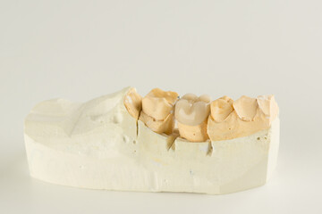 metal ceramic dental crown photographed close-up