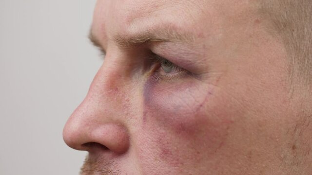 Man with bruise uner eye
