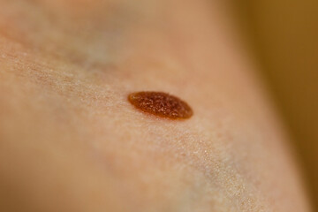 Closeup brown mole on skin.