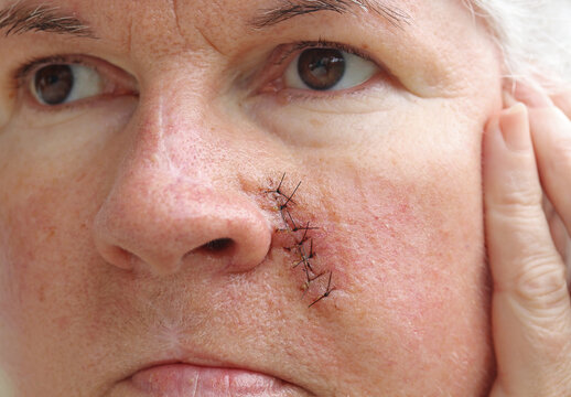 Eine ältere Frau hat eine Operationsnarbe im Gesicht