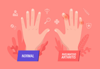 Normal and Sick Hands with Rheumatoid Arthritis, Osteoarthritis. Finger Joints Inflammation Medical Healthcare Concept.