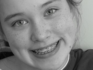 close up portrait of a girl with braces smile on black and white