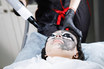 Laser carbon peeling procedure for face skin.