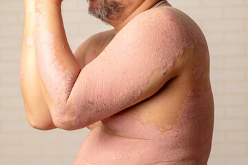 Diseases caused by abnormalities of the lymph. Psoriasis is a skin disease.