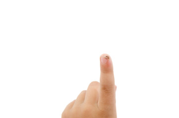 wart or papilloma on the index finger of a child / isolated on white / close-up. - obrazy, fototapety, plakaty