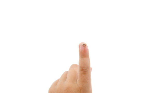 wart or papilloma on the index finger of a child / isolated on white / close-up.