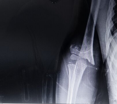 X-ray of broken elbow on a black background.