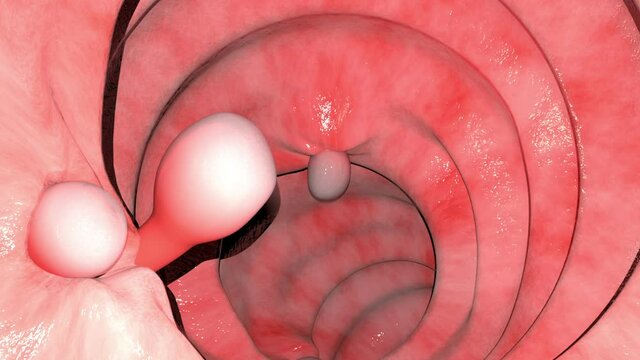 Overview of the Intestinal Polyps