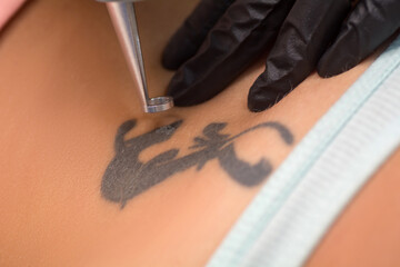 Laser tattoo removal procedure. Salon equipment.