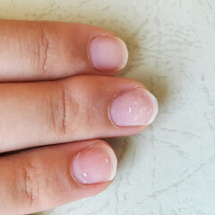 A bulge appeared on the tip of the student's middle finger due to the fact that he used the pen too often. Deformity and callus of the finger.