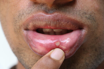 Stomatitis on the lip of an adult. Accidental injury on the lip