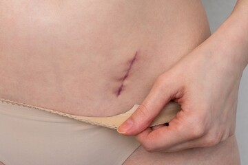 Person shows on belly scar from a appendix, closeup