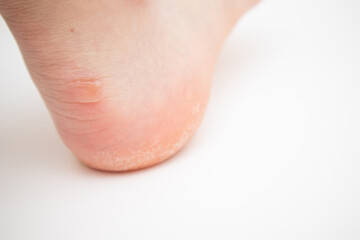 Big callus on heel. Feet with callus of dead skin.