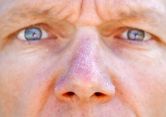 Man with peeling sunburned nose