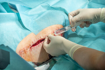 doctor infiltrates a surgical wound with a local anesthetic in a syringe