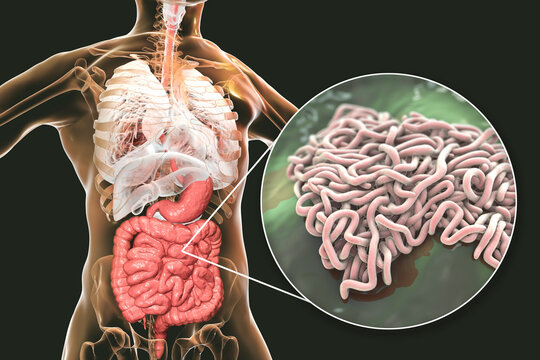 Parasitic worms in human intestine