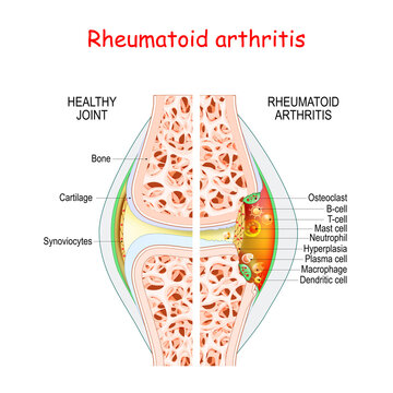 Rheumatoid arthritis. Healthy and damage joint.