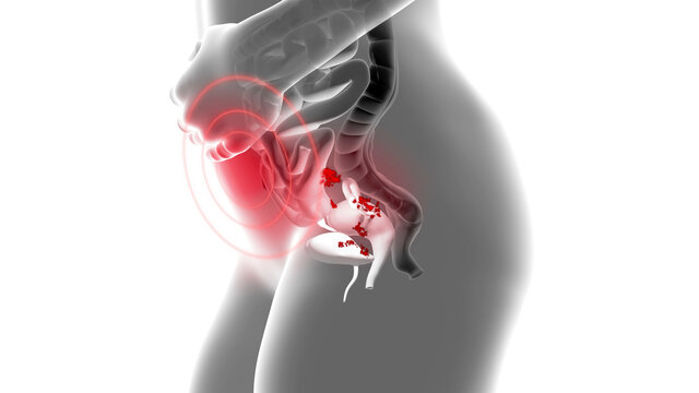 Illustration of the female disease endometriosis, educational, medical 3D illustration