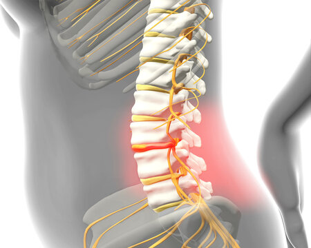 Spinal disc herniation causing lower back pain, 3d illustration