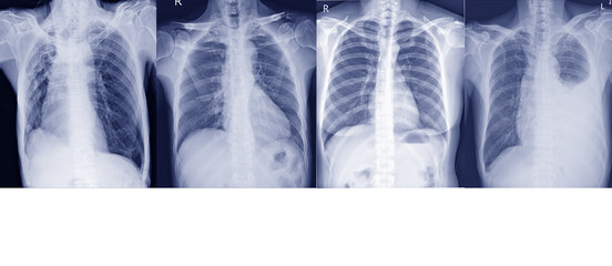 Collection chest x-ray for  doctors and medical professionals. To learn the disease.Healthcare concept.