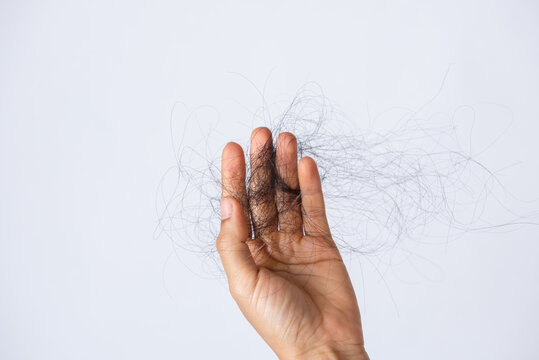 Hair Loss Problem On Hand Isolated On White Background. Loosing Hair Or Breast Cancer. Close-up Of Cancer Patient Girl Hands Showing Her Lost Hair.