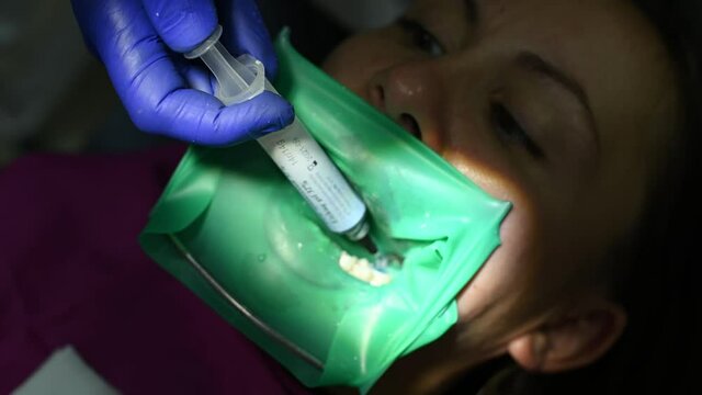 The patient in a chair in the dentist's office, performs dental procedures, dental treatment, filling the tooth cavity with fillings.