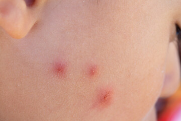 Insect bites on a newborn's face that triggered an allergic reaction