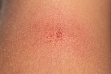 Symptoms of an eczema on the skin of a young woman