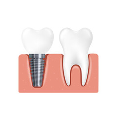 Gum with dental implant and normal tooth realistic vector illustration isolated.