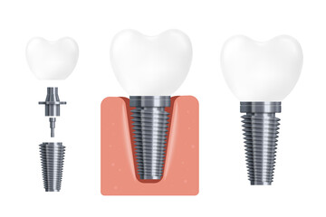 Dental implant construction, flat cartoon vector illustration isolated