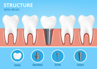 Dental implant structure with fixture, flat cartoon vector illustration