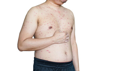 Chickenpox on the body isolated on white background, infection caused by the varicella-zoster virus.