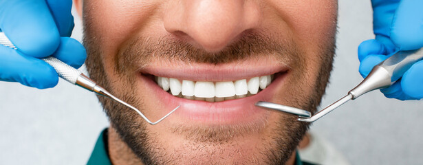 Healthy white male smile with a periodontal probe and mouth mirror, close-up. Teeth treatment. White teeth close up
