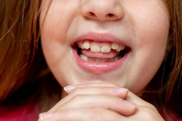 
malocclusion