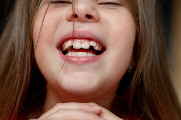 
malocclusion