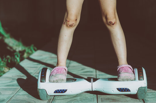 Young Girl With Badly Bruised Knees Standing On A Hover Board