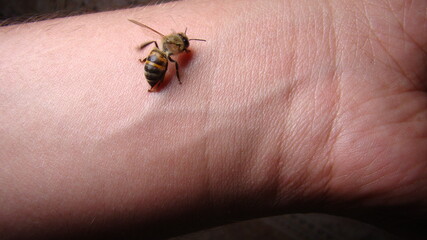 bee : apis mellifera treatment by honey bee sting closeup honey bee stinging a hand close up bee...