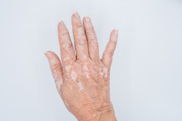 Vitiligo skin disease on hand closeup on isolated white background.