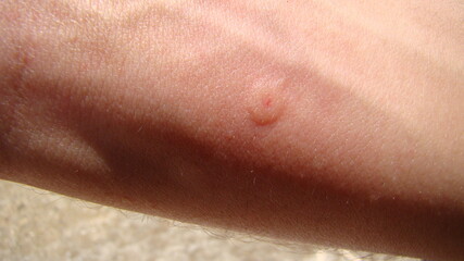 Fototapeta premium bee : stung by a bee worker. skin allergy , allergic treatment by honey bee sting closeup honey bee stinging a hand insects, insect, animal, wildlife, wild nature, forest, garden beauty of pollination