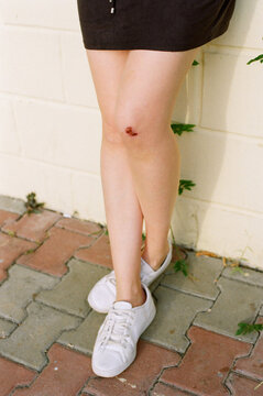 Young woman with scraped knee
